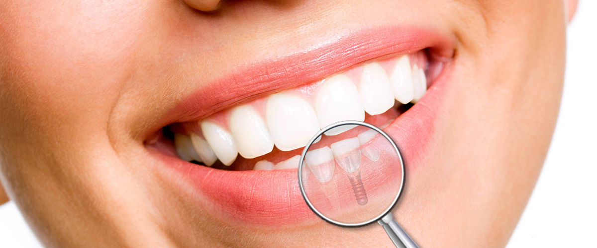Implante dental