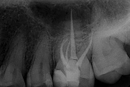Endodoncia implantes dentales