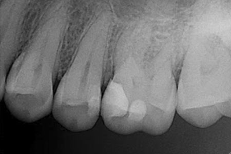 Endodoncia