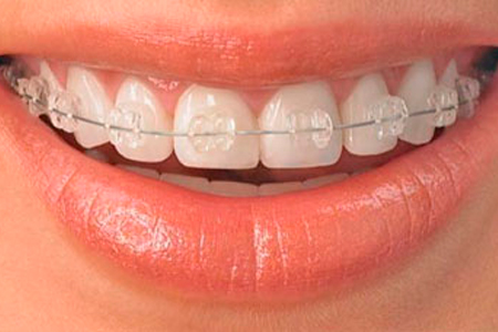 Tratamiento de braquets ceramicos claravilla braquets ceramicos