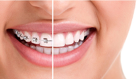 ortodoncia antes y depues