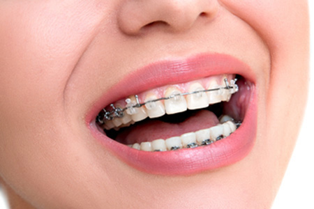 Ortodoncia Brackets
