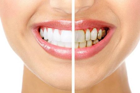 Dientes blancos antes y despues