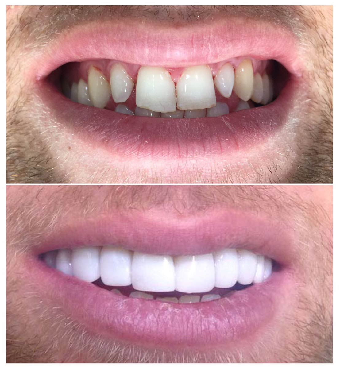 sonrisa perfecta, Diseño de sonrisa antes y despues