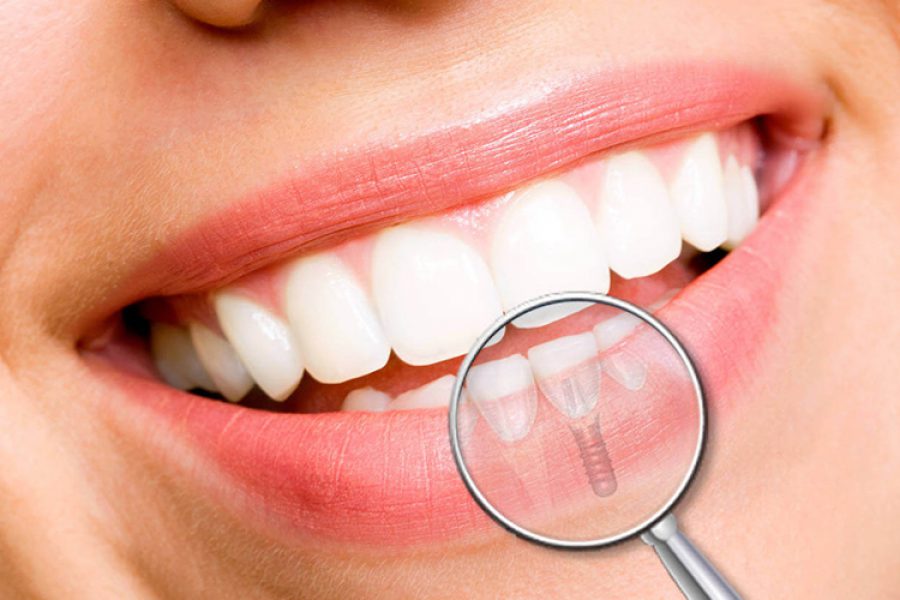 Implantes Dentales o Vivir con Dentadura Postiza